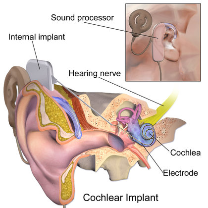 Cochlear implant in nashik