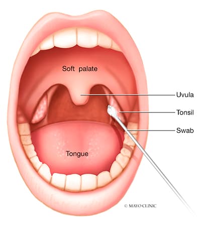 Tonsillitis treatment in nashik